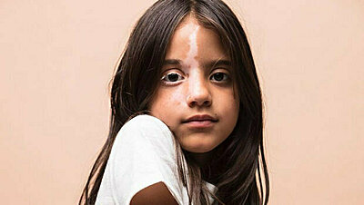 حوار مع ميلا: طفلة مصابة بالبهاق وتصدرت غلاف أشهر المجلات