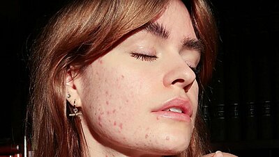 From Ages 25-30: Why We Get Adult Acne and How to Get Rid of It