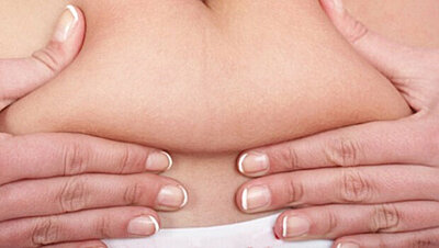 Seven Facts About Stretch Marks
