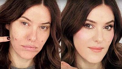 A Makeup Artist's Magic Contour Trick to Hide Big Swollen Pimples!