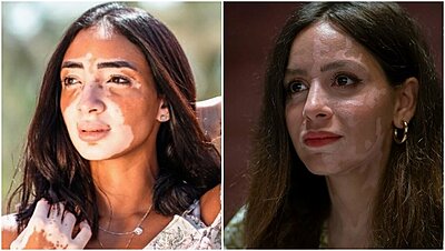 Empowering Vitiligo Personal Stories and Important Self Love Messages