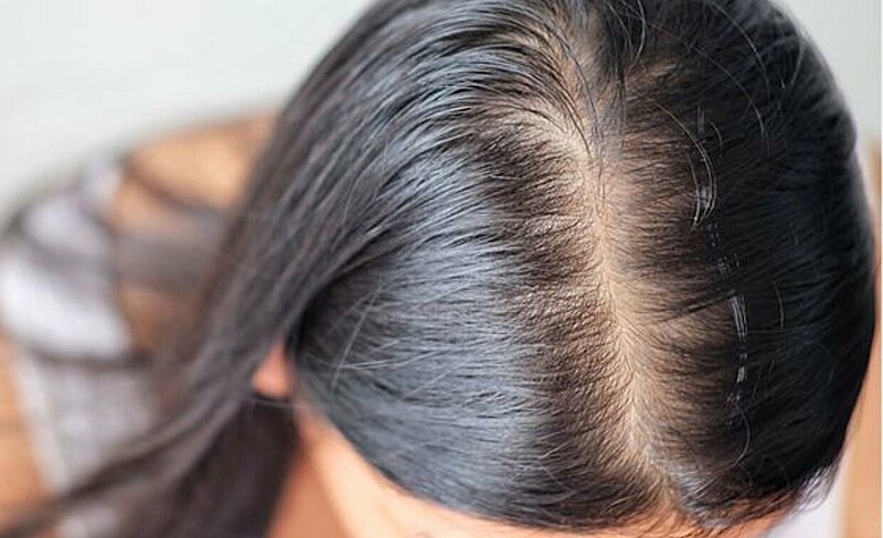 Thinning Hair Causes and Treatments