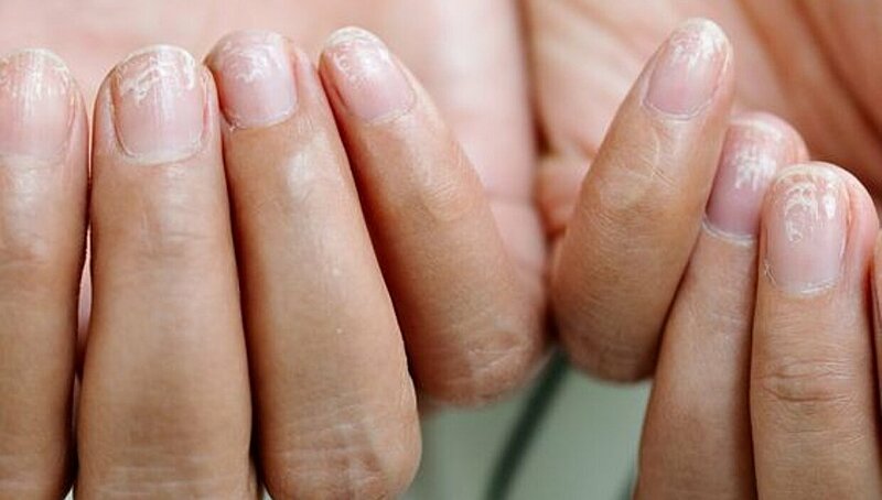 Easy Remedies You Need to Stop Splitting Nails